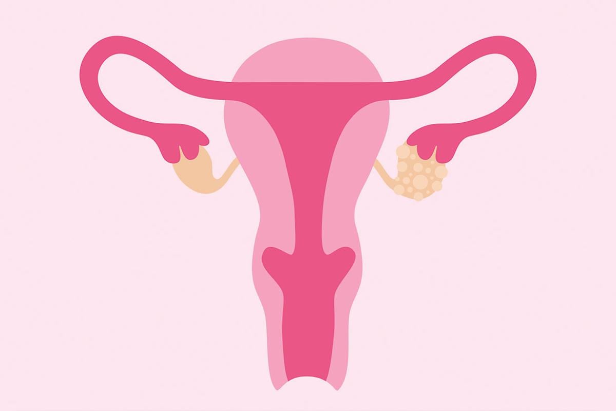 Female reproductive system with ovarian cysts