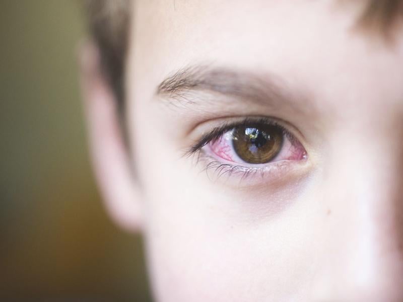 Child with pink eye