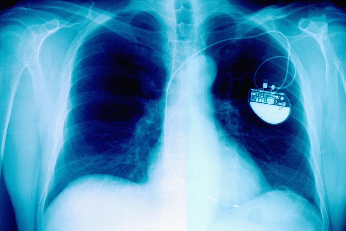 Xrays showing an implanted medical device