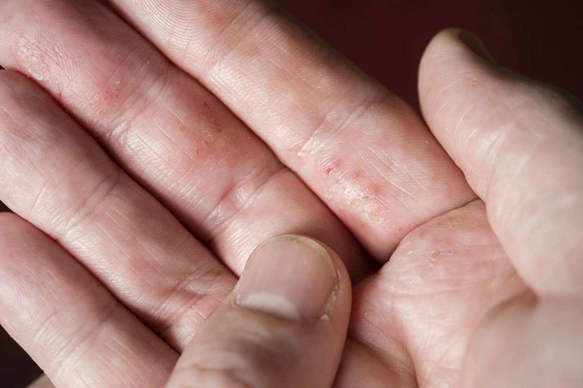 Small blisters on a hand