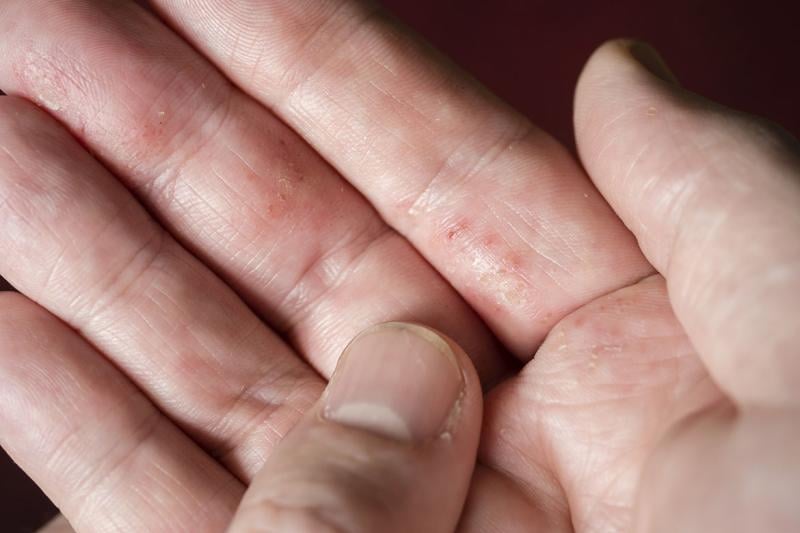 Small blisters on a hand